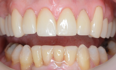 After treatment - Clear Aligners and Crowns/Veneers 