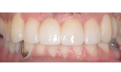 After treatment - Crowns/Veneers and Dentures