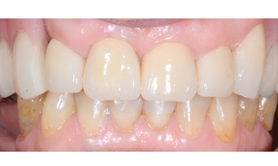 After treatment - Dentures, Crowns and Bite Reconstruction