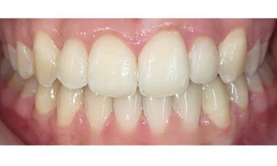 After treatment - Fixed Braces