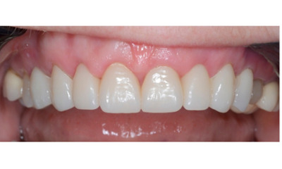 After treatment - Gum Lift, Crown and Veneers 