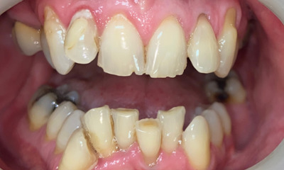 Before treatment - Clear Aligners and Crowns/Veneers 