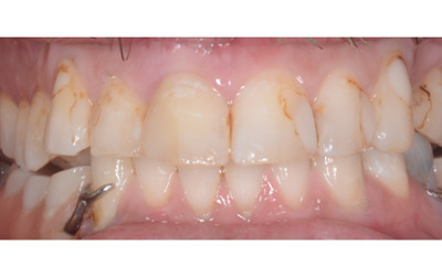 Before treatment - Crowns/Veneers and Dentures