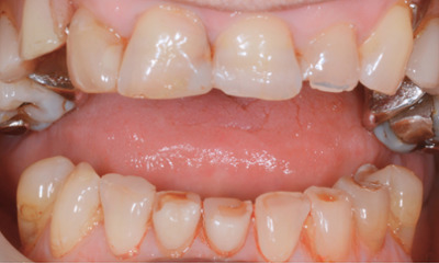 Before treatment - Dentures, Crowns and Bite Reconstruction