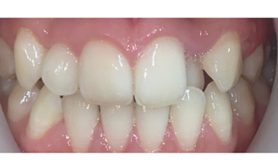 Before treatment - Fixed Braces