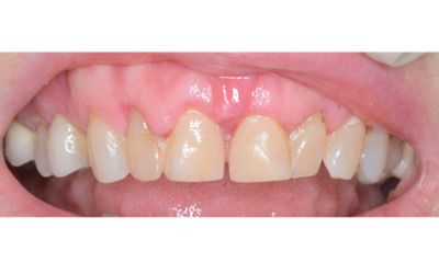 Before treatment - Gum Lift, Crown and Veneers 
